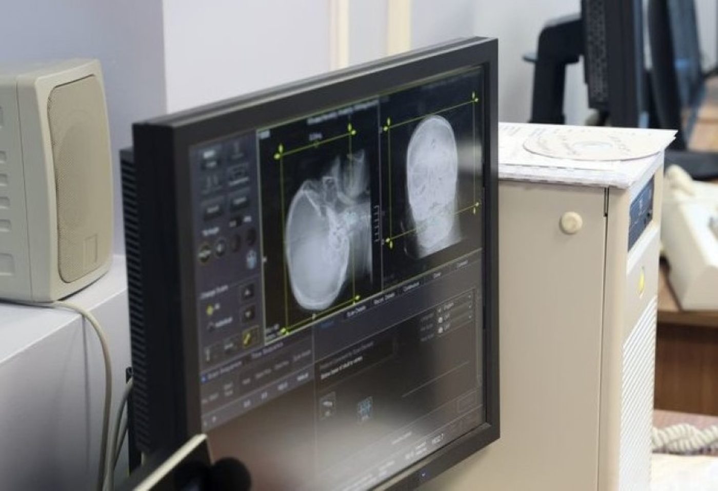 Врач: инсульт возникает на фоне хронических болезней - их нужно лечить