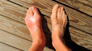 Подагра: что это за болезнь, кто от нее страдает и какая при ней нужна диета?