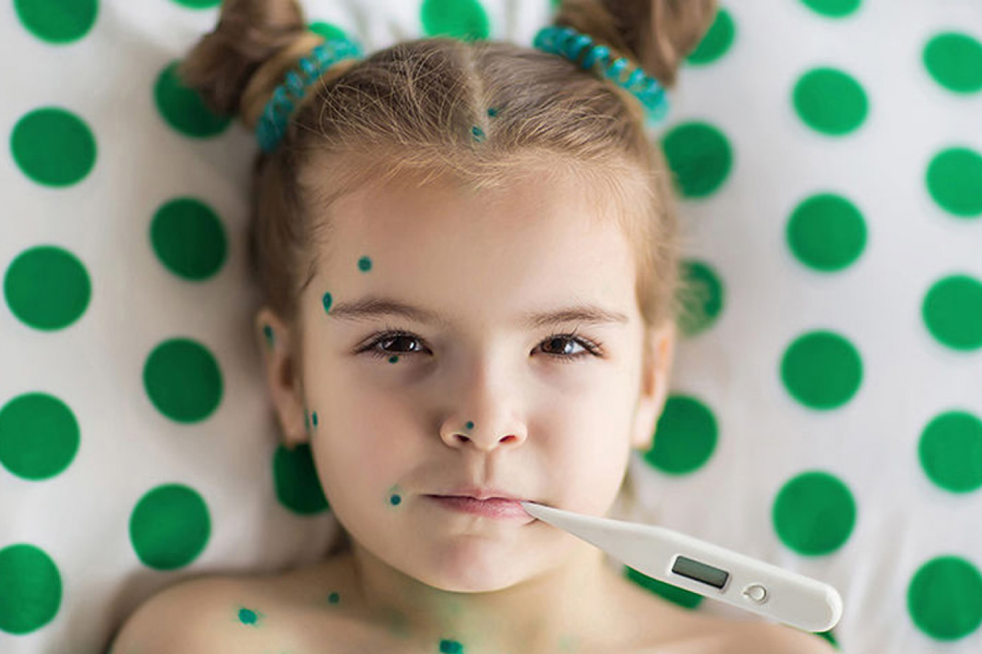 Врач-эпидемиолог о профилактике ветрянки