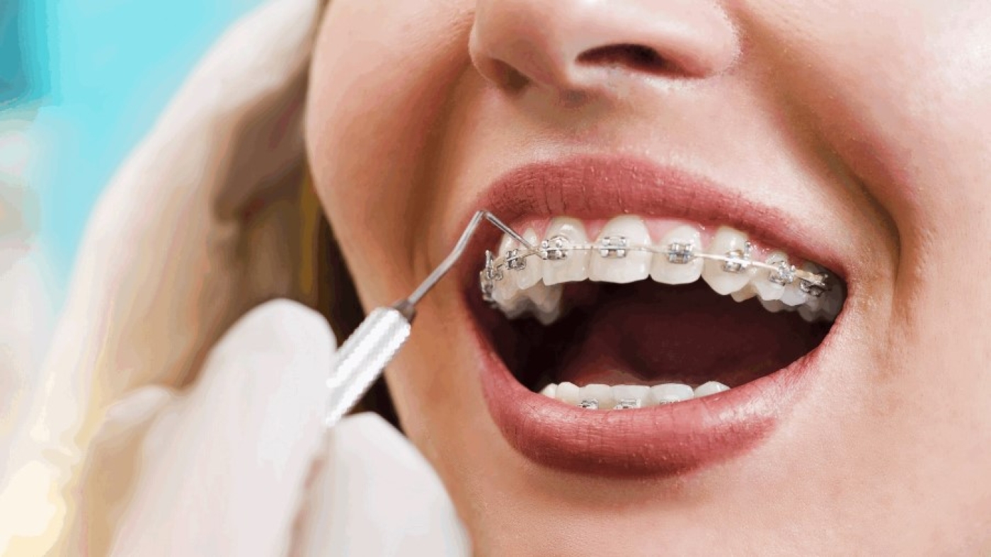 Врач назвал распространенные мифы о продуктах, которые нельзя есть во время ношения брекетов