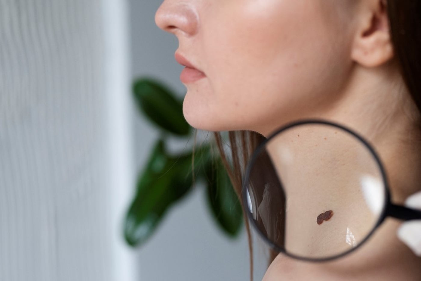 Специалист объяснила, как понять, что родинку нужно показать врачу