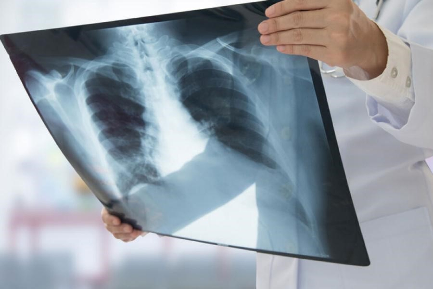 Смертность снизилась в 4,5 раза. Прогресса в лечении туберкулеза достигли в Беларуси