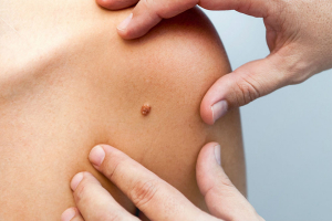 Врач-эпидемиолог рассказал о вирусе папилломы человека