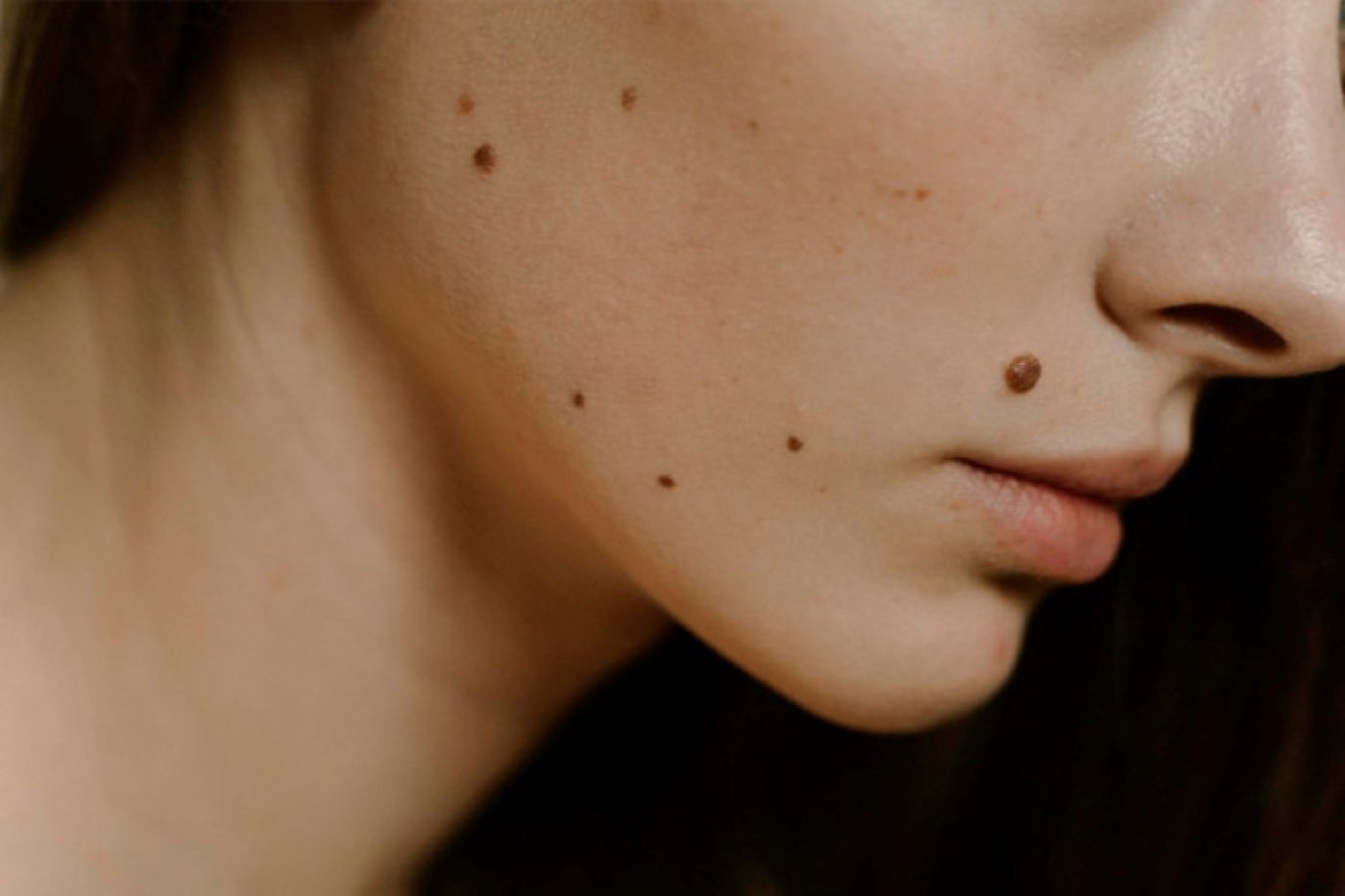 Это не родинка! Какие образования могут появляться на коже и из-за чего?